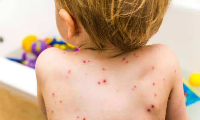 treating chickenpox symptoms at home