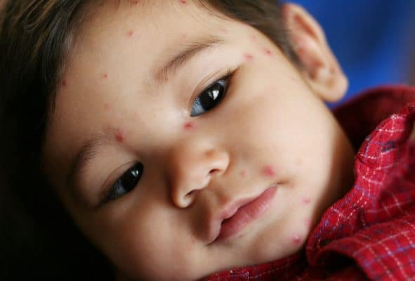 chicken pox shingles difference baby