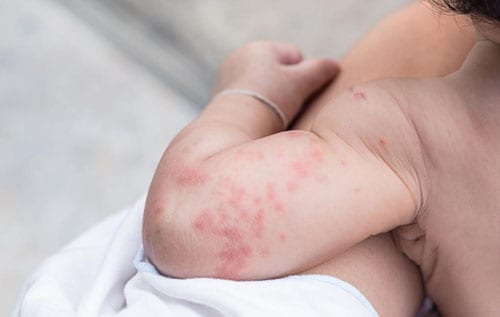 shingles rash babies